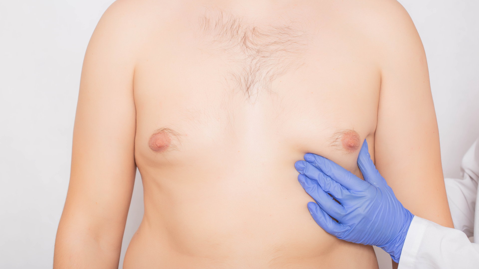 Man getting Gynecomastia treatment